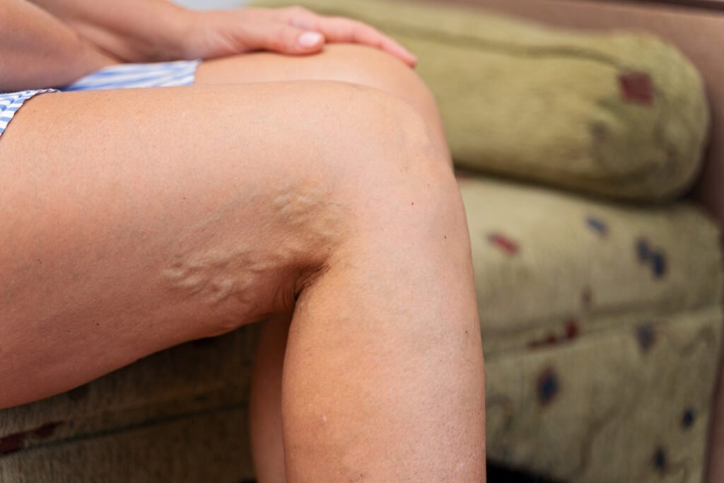 Αισθητική φλεβολογία