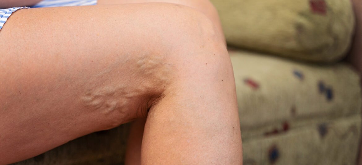 Αισθητική φλεβολογία