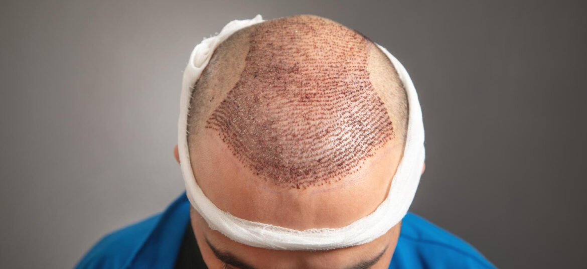 μεταμόσχευση μαλλιών και ηλικία