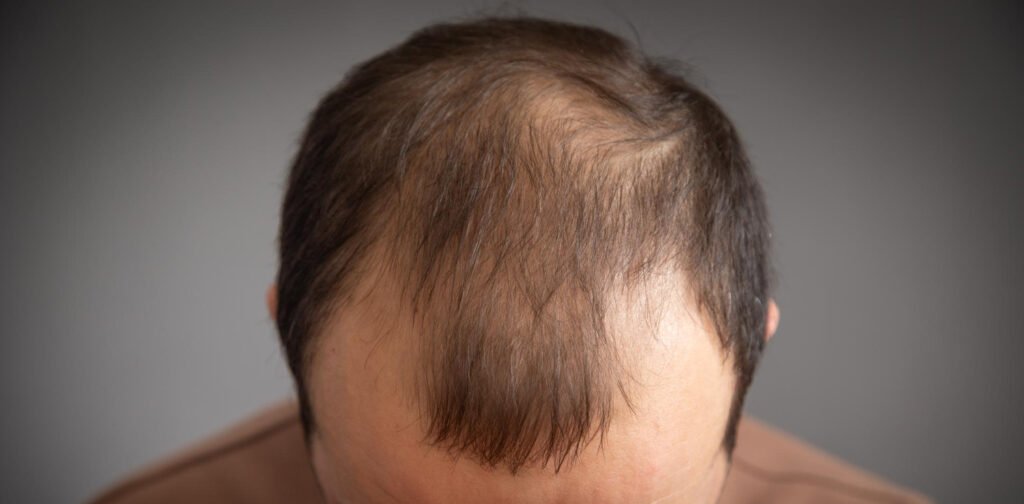 Body hair transplant: Can beard or chest hair be used?