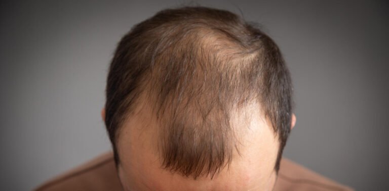 body hair transplant
